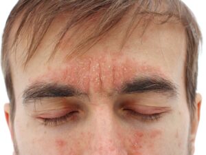 SEBORRHOIEC DERMATITIS