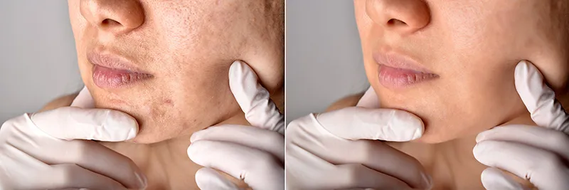 chemical peels
