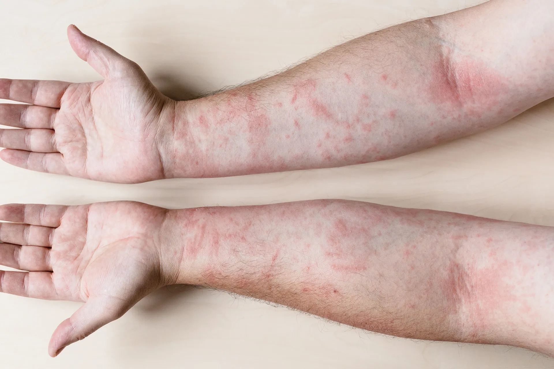 arm with inflamed skin condition