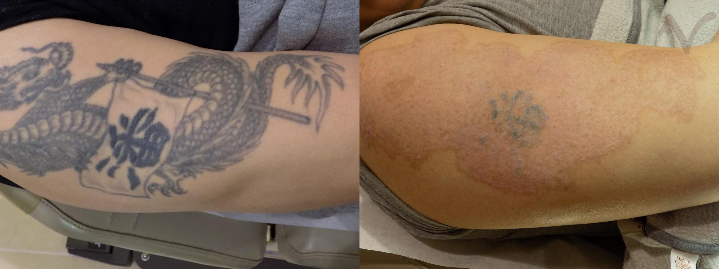 pico laser tatto removal