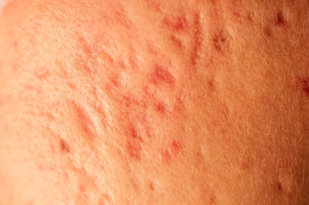 post acne scars and red fastering pimples