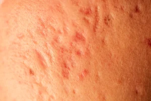 post acne scars and red fastering pimples