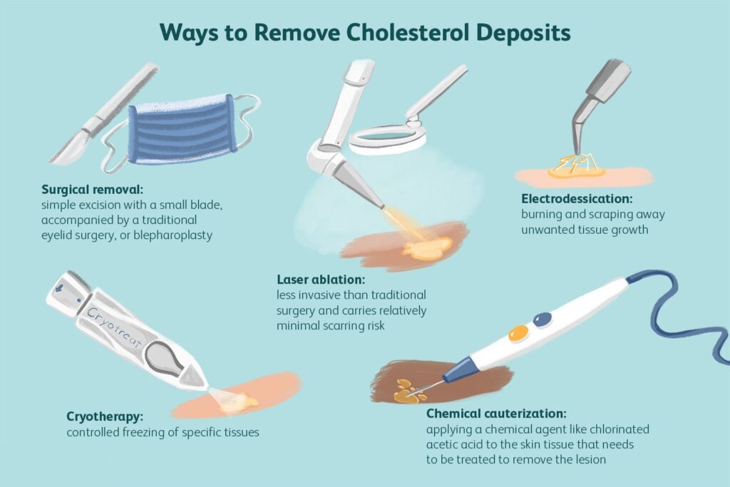 Ways to Remove Cholesterol Deposits