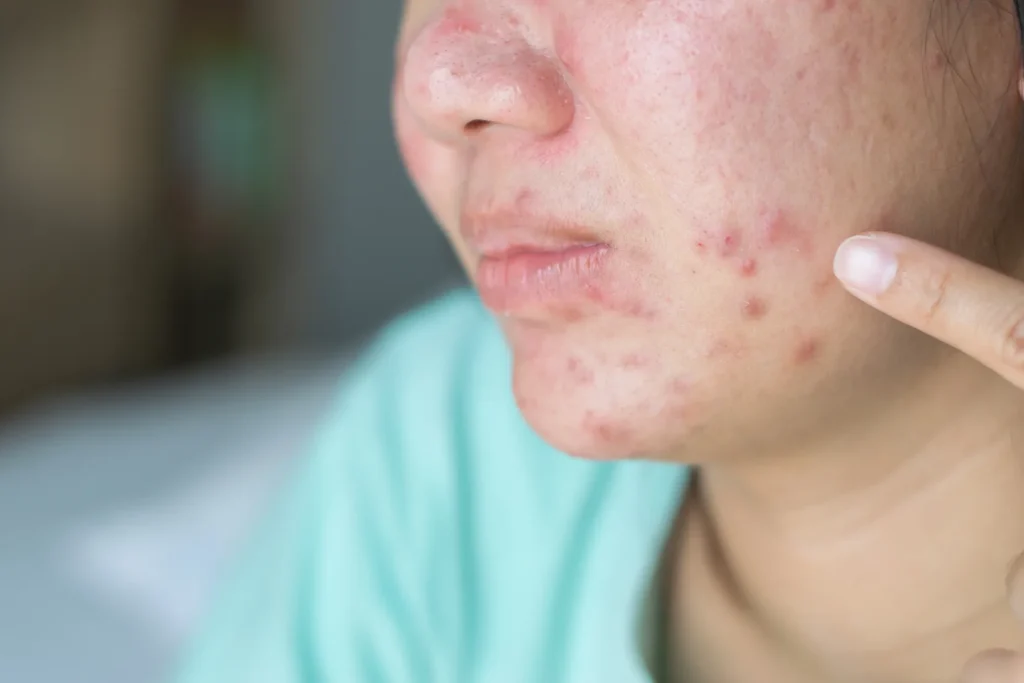 close up of asian girl skin problem cheek