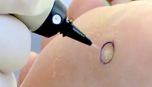 cryotherapy wart removal