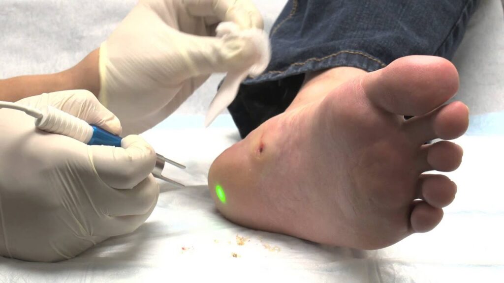 laser removal wart foot