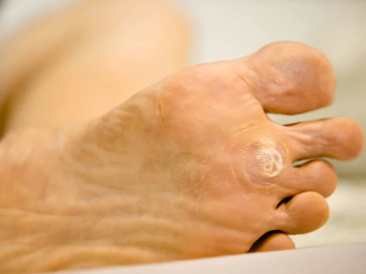 planter wart foot