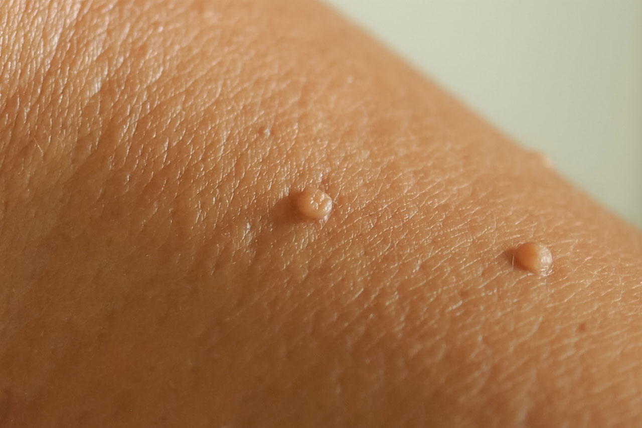 Memahami Punca Skin Tag Gejala dan Rawatan