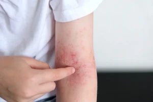 child scratches atopic skin
