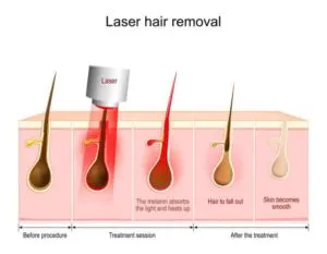 Rawatan Laser Buang Bulu
